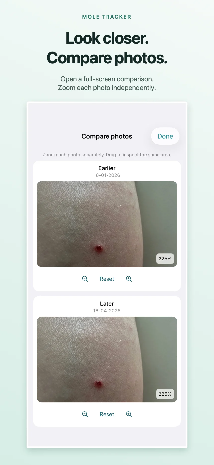 Mole Tracker's full-screen comparison showing two dated photos, each with its own zoom controls.